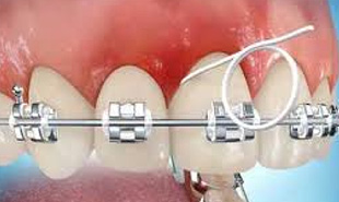 کشیدن نخ دندان در ارتودنسی